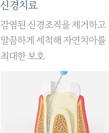 신경치료