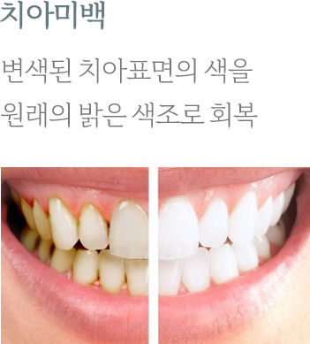 치아미백
