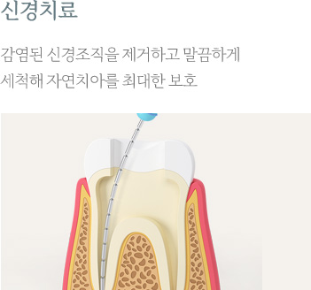 신경치료