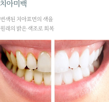 치아미백